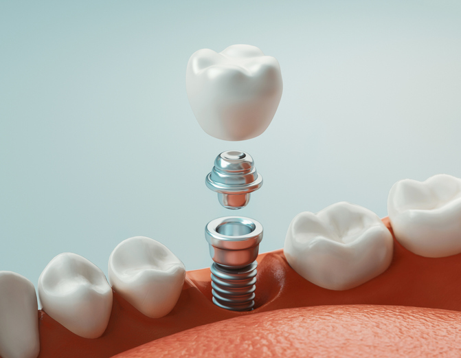 Dental implants: What to Expect Before, During, and After Treatment |